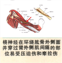 桡神经损伤康复训练 65412b55085940f5b08471d96abb3c7e.png