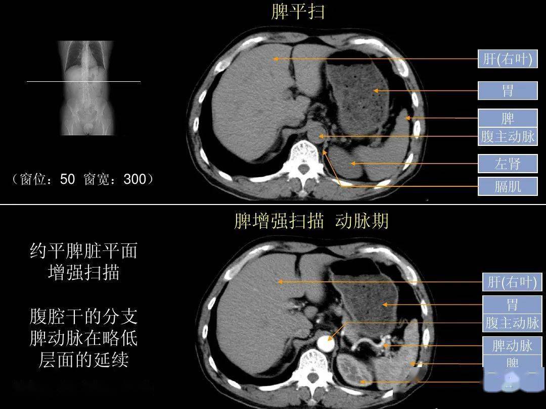 腹部ct入门解剖图谱收藏版