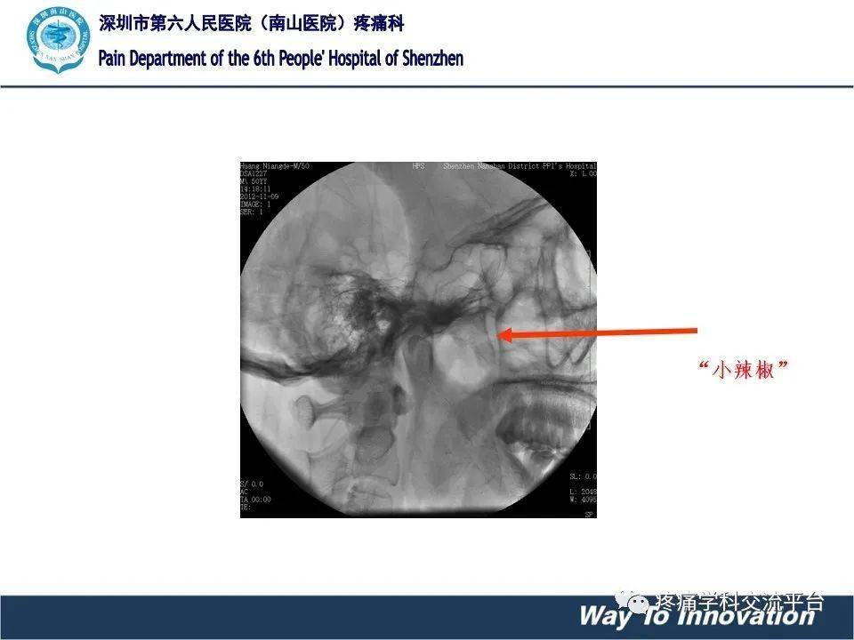 带状疱疹是什么原因引起神经疼 a3a94794ae764f4c8b9d4cfb6cb38222.jpeg