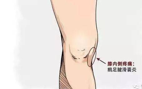 痛病悟源--膝关节疼痛之源