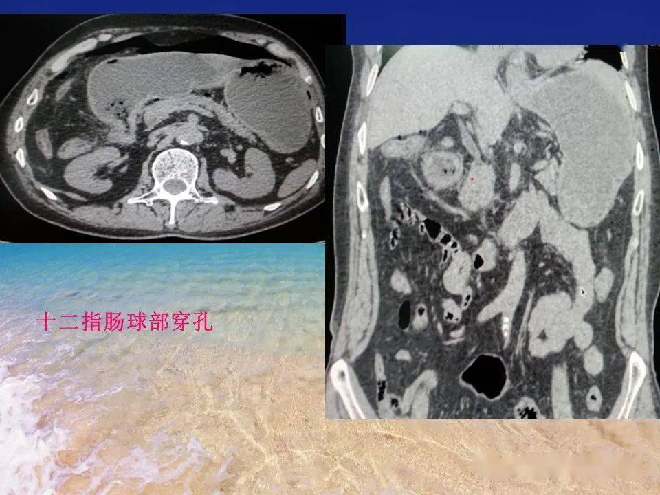 消化道穿孔的ct诊断