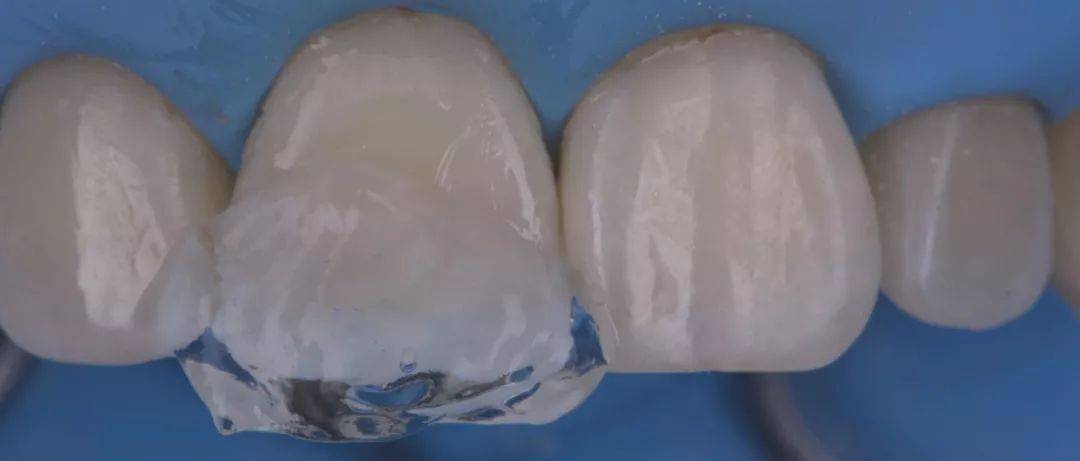 【病例分享】中切牙的修复:复合树脂直接修复vs全瓷贴面修复