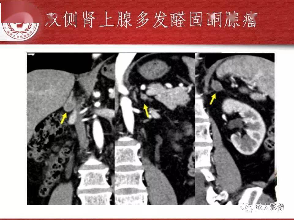 常见肾上腺疾病影像诊断