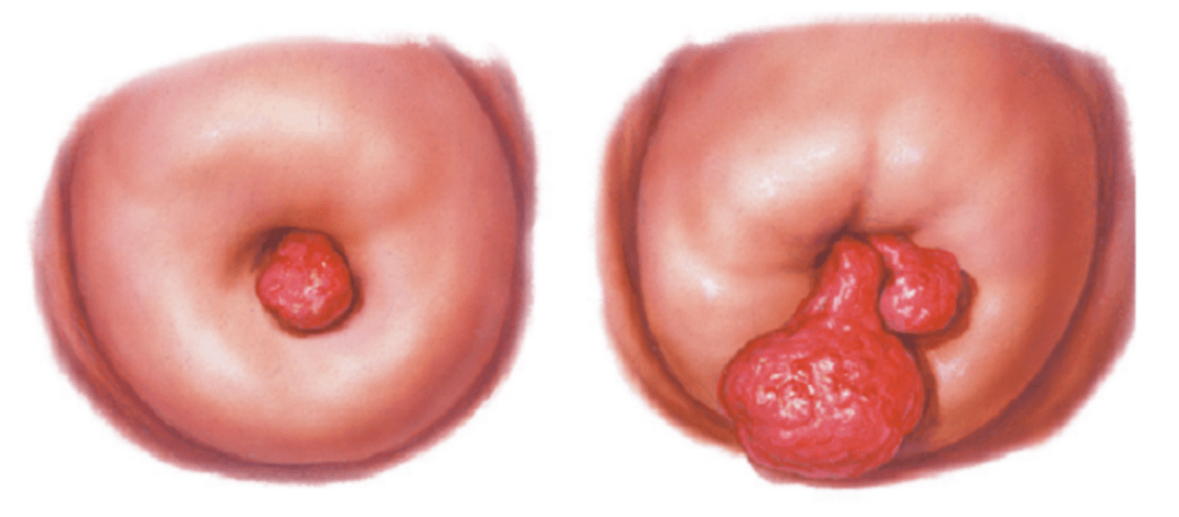 大多数的宫颈息肉可以没有任何症状,是在妇科体检时医生检查出来的.