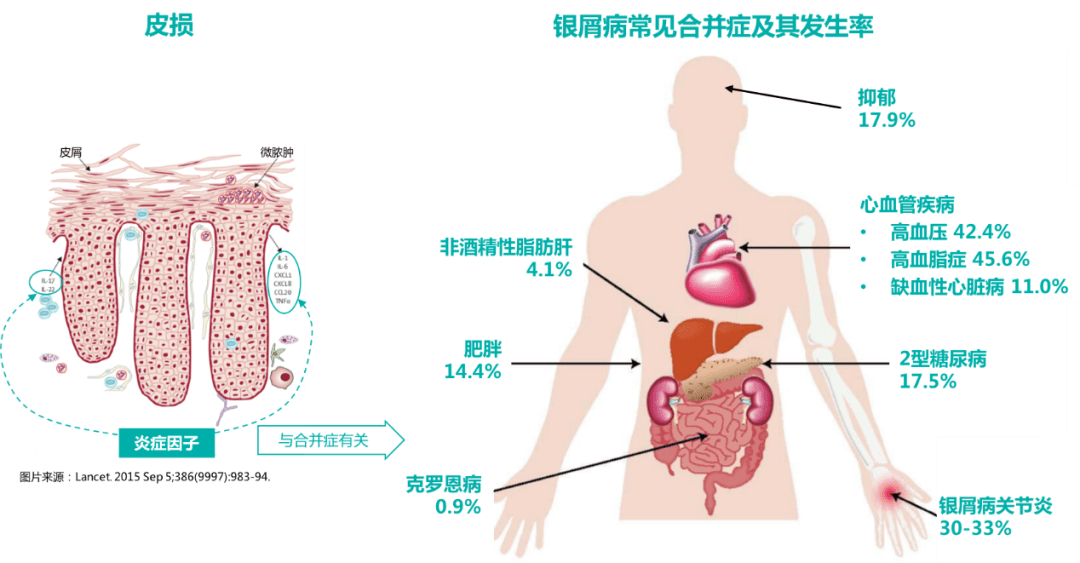 烫伤后摸盐是什么原理_二级烫伤是什么概念(3)