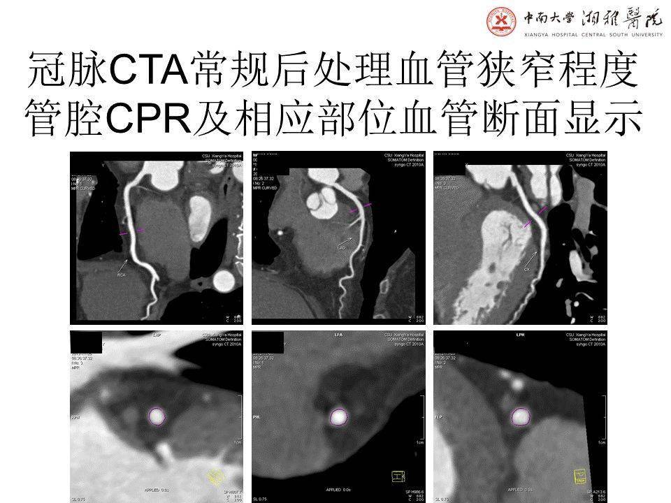 湘雅医院冠脉cta标准化图像后处理及规范化诊断报告书写