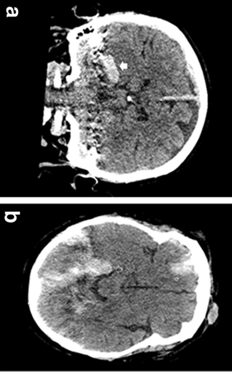 ct扫描显示硬膜下血肿和小脑幕积血(图 a 和 b)