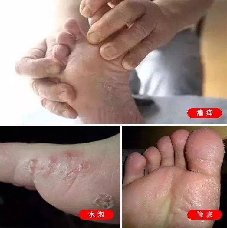 人的脚上分布有超过25万条汗腺  爱出汗的双脚在闷热的鞋子里无法蒸发