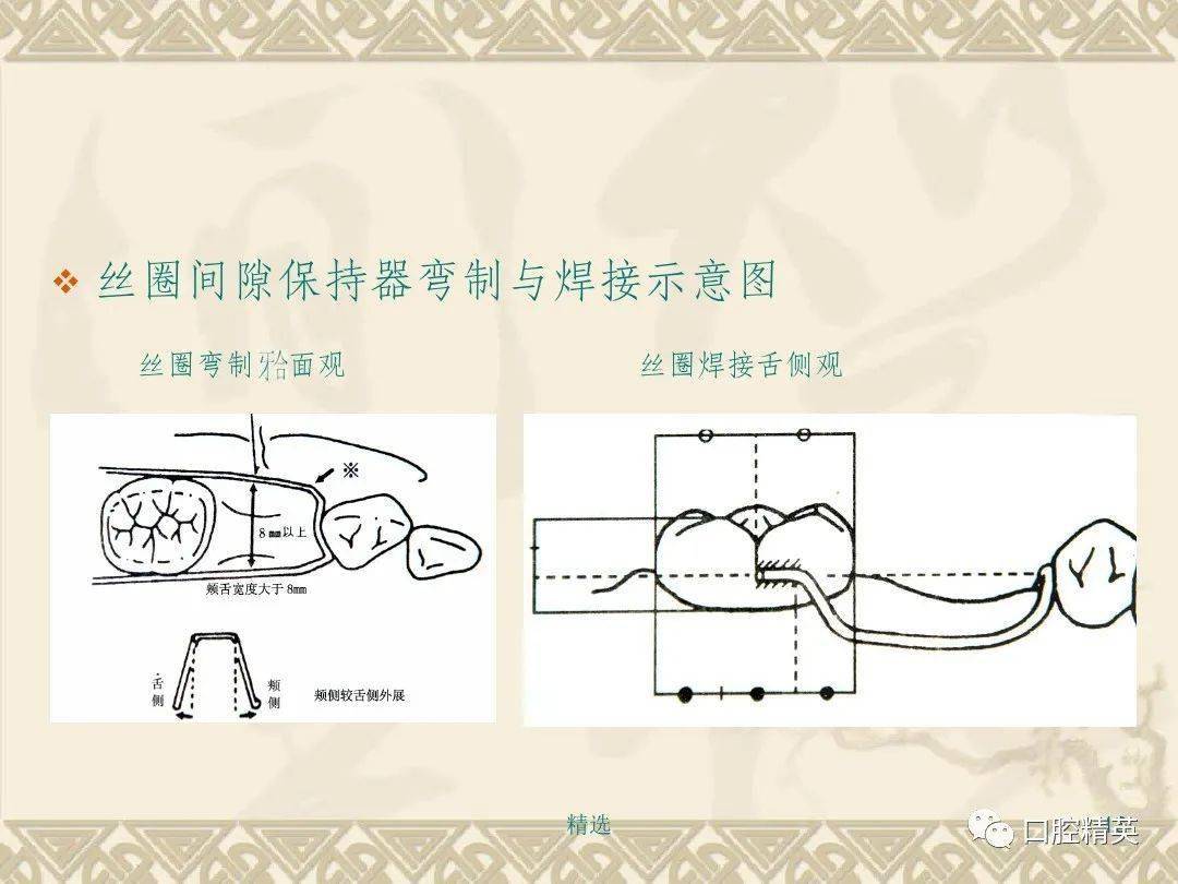 间隙保持器的设计和制作