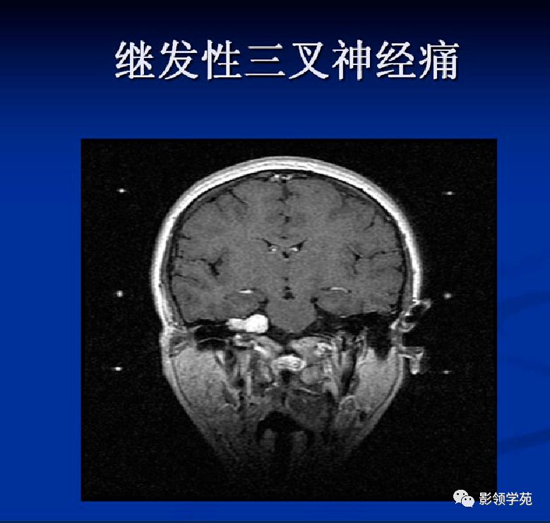 可见增粗的三叉神经三叉神经鞘瘤伽玛刀后明显缩小三叉神经瘤三叉神经