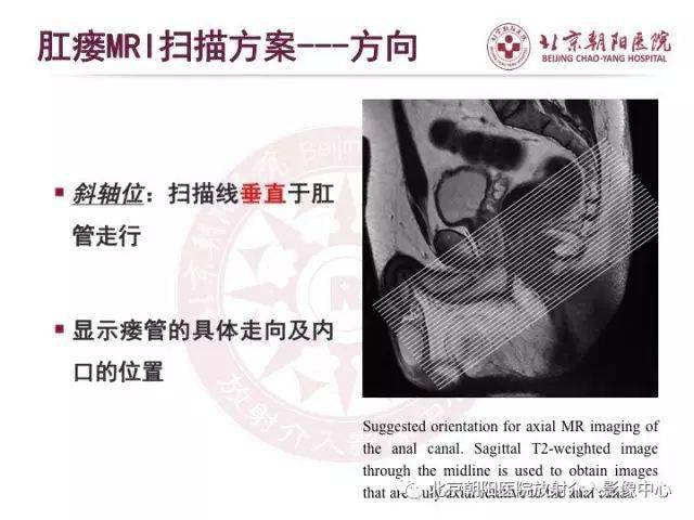 图解肛瘘的解剖和影像诊断