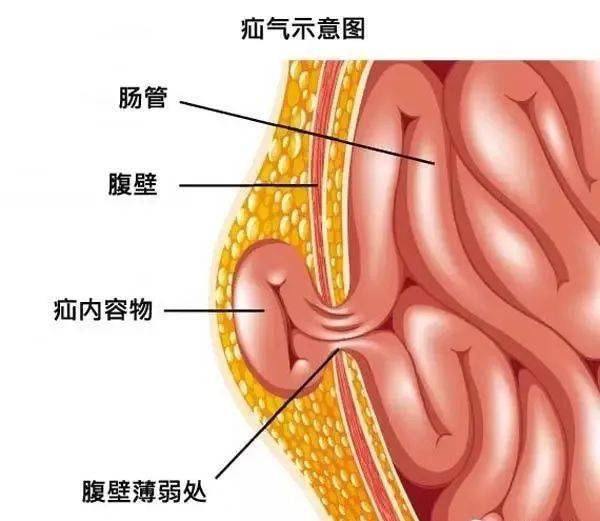 男性 由于胎儿时期, 男性睾丸是在腹腔里,随着发育,睾丸从腹腔下降到