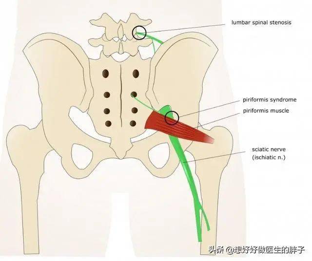 【月太体检】腰椎间盘膨出,腰不疼一侧屁股疼,疼得走不了路有什么办法