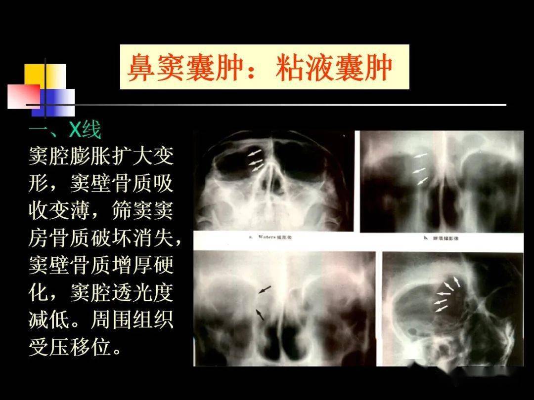 鼻及鼻窦影像解剖及相关疾病影像诊断