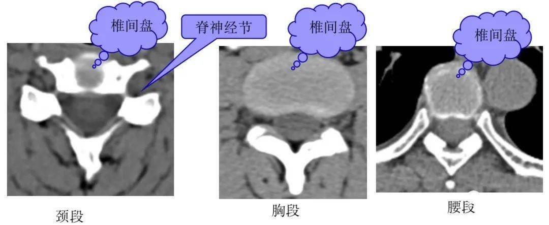 经椎间盘的横断层面: 断面经过的部位:椎间盘 主要特征:椎管呈不完整