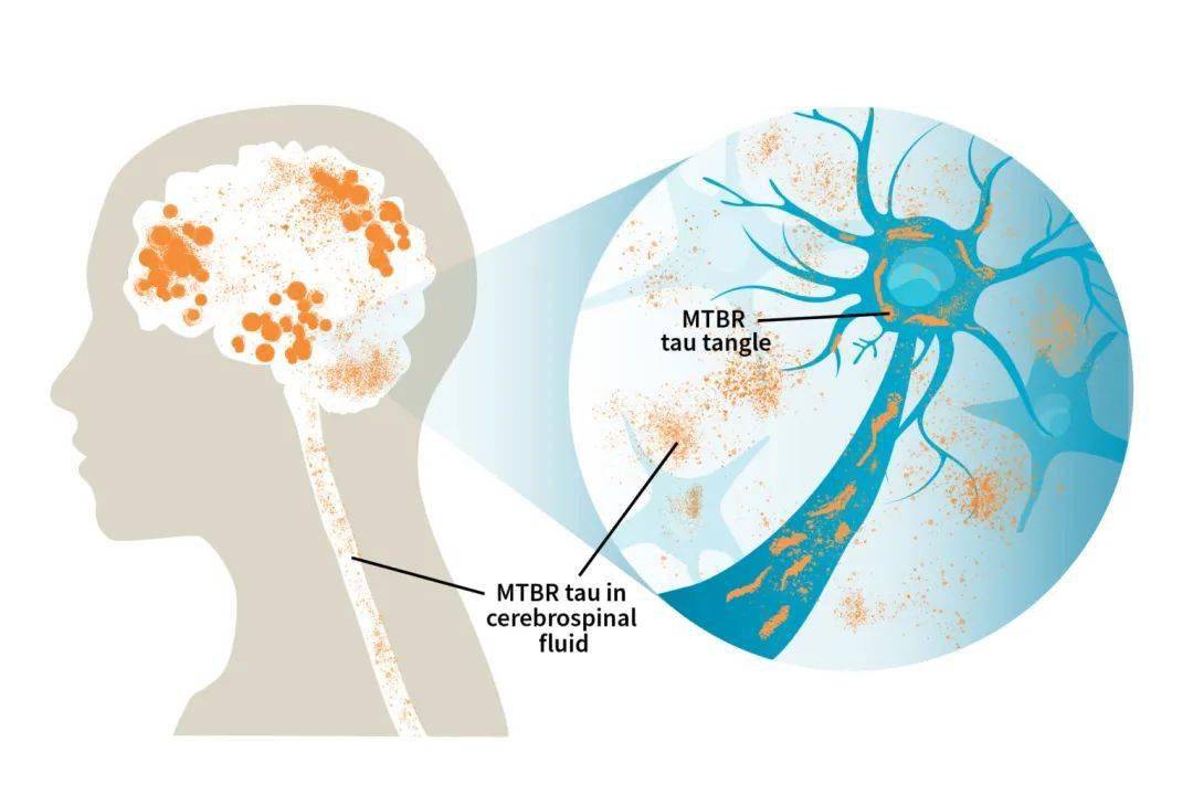 《brain:脑脊液中发现的新型阿尔茨海默病蛋白表明了疾病的阶段