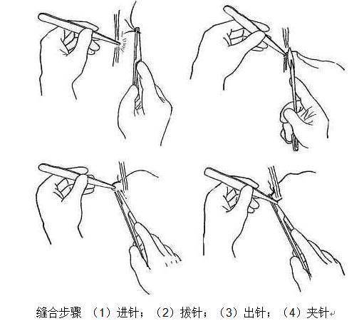 将针完全拔出,由第一助手打结,第二助手剪线,完成缝合步骤
