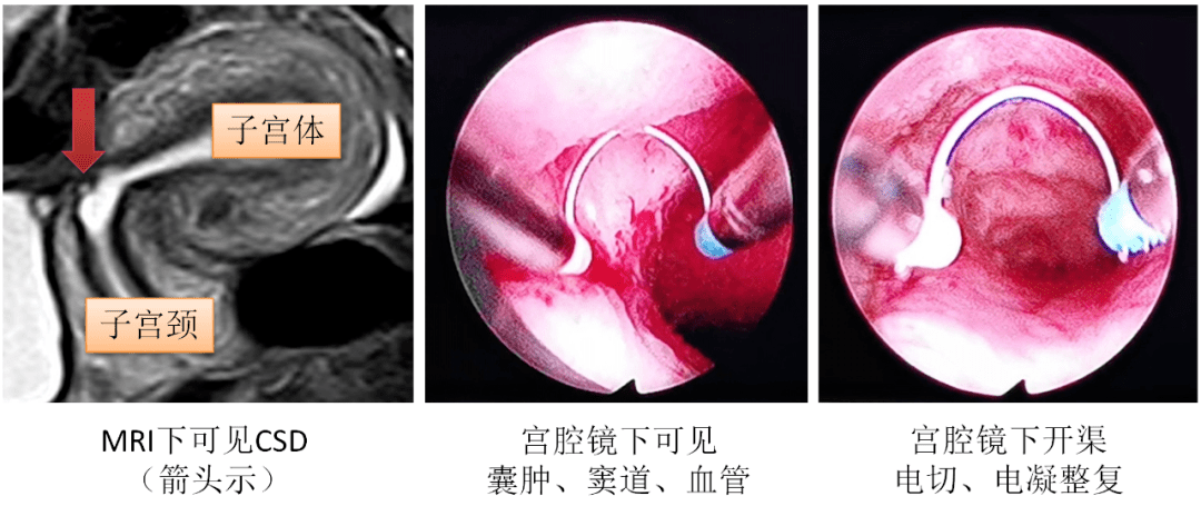 有继续生育的计划,要求手术减轻症状,于是进行了宫腔镜下子宫憩室手术