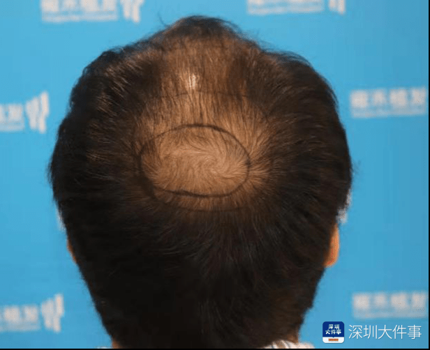 深圳植发医院排行_深圳植发需求升级,雍禾植发倡导行业健康发展