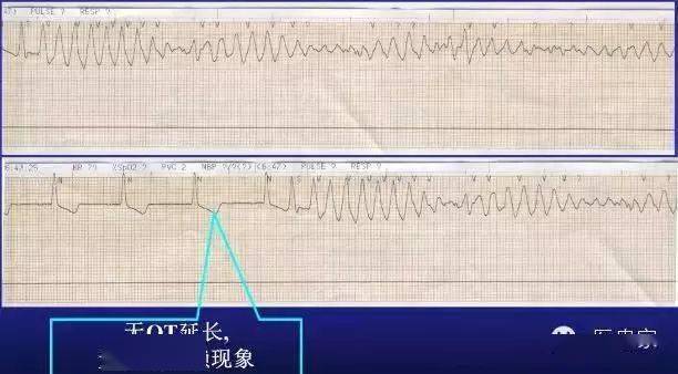 尖端扭转室速