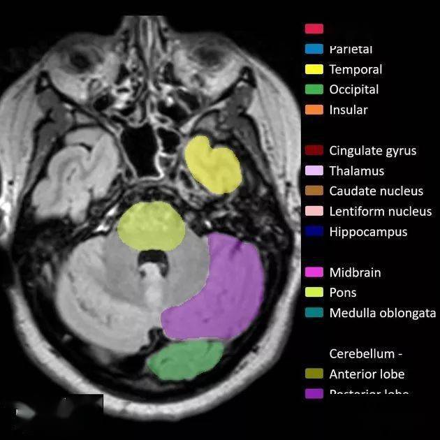 mr入门丨脑叶解剖分布mri图像彩色标注
