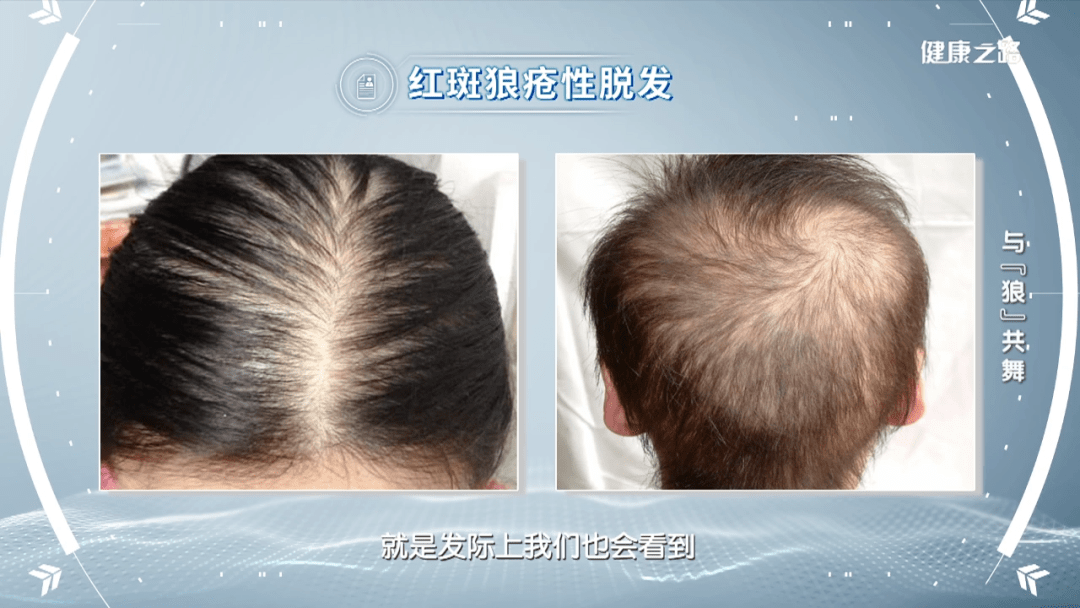健康科普行动:红斑狼疮是不治之症吗?会遗传吗?