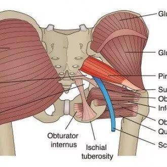 到底是梨状肌综合征还是腰椎间盘呢?_手机