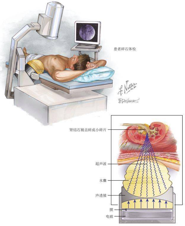 体外冲击波碎石是目前最先进的无需手术而治愈泌尿系统结石的新技术.