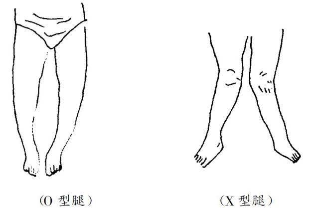 o型腿和x型腿产生的原因及治疗方法