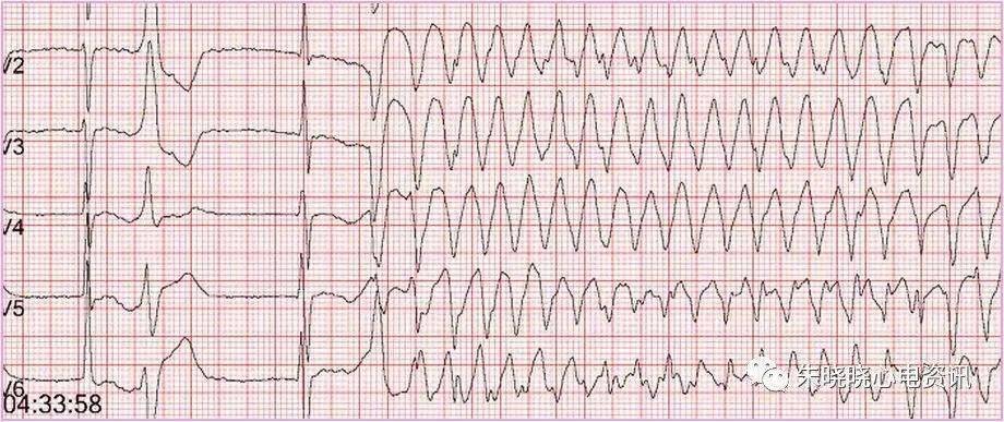 识别致命的心电图!_心室