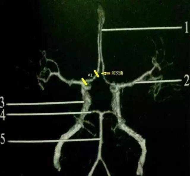 【推荐】大脑前,中,后动脉的分段图解