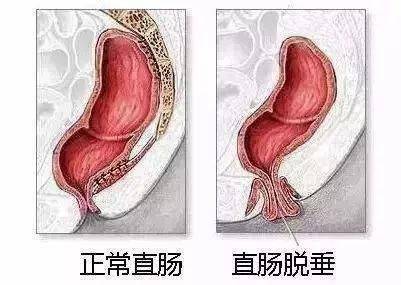 这是肛门直肠脱垂的  主要症状,早期排便时直肠粘膜脱出,便后自行复位