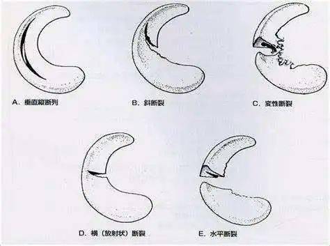 骨科大夫:半月板损伤,究竟哪些可以保守治疗,哪些要做手术?