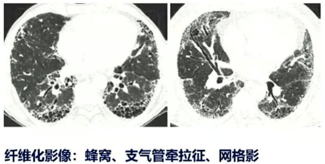 图4. 肺纤维化影像