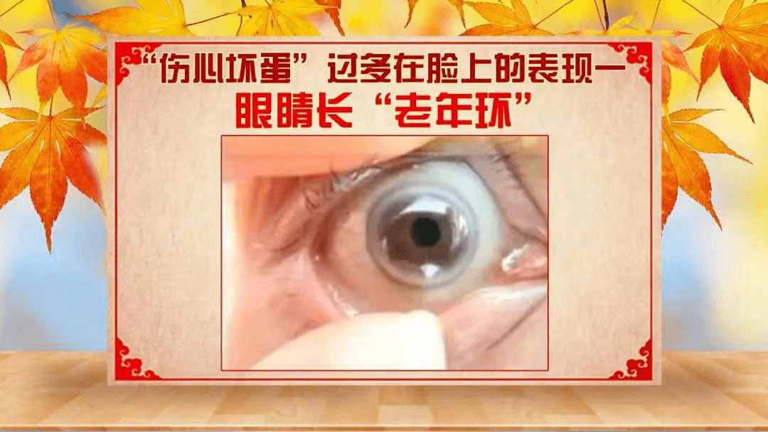 2 老年环 眼角膜周围出现一圈宽约1-2mm的,灰白色的环,就是角膜老年环