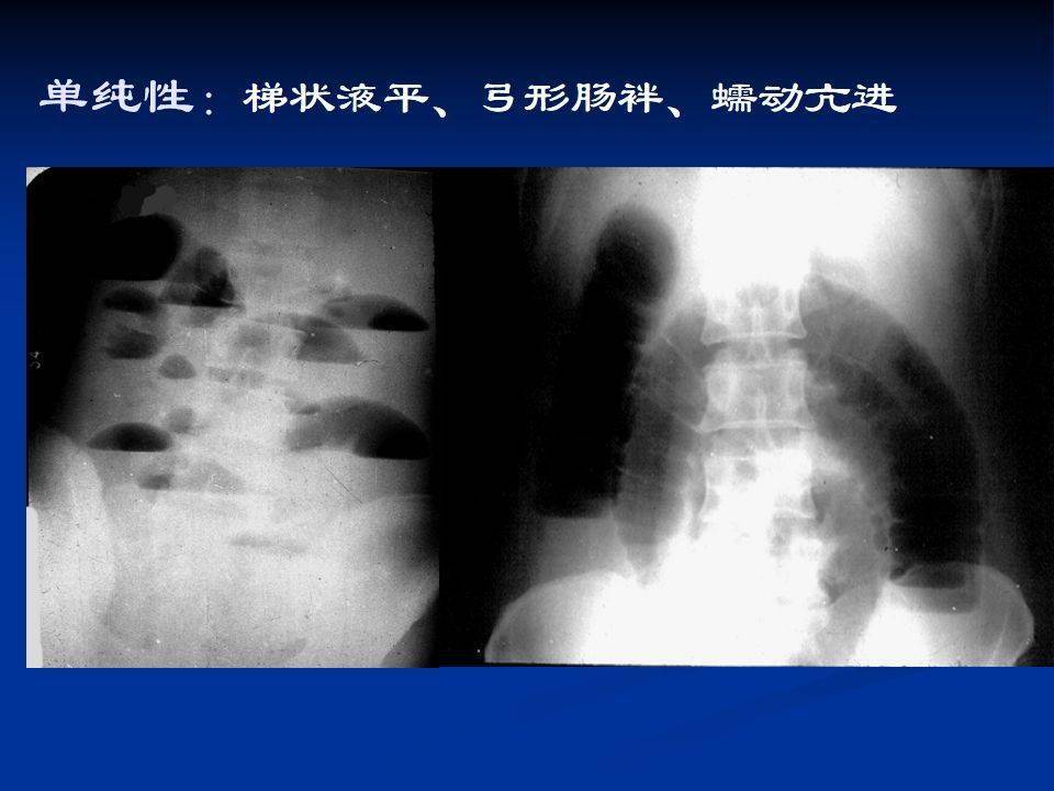 高清图片文字讲解肠梗阻的分类及影像学表现