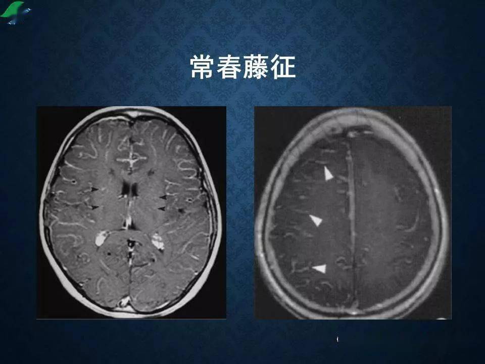 烟雾病的影像学诊断