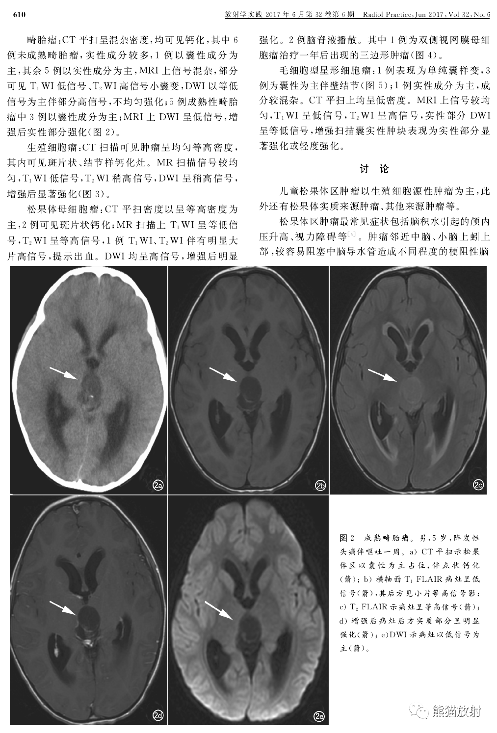 图文讲座丨儿童松果体区肿瘤的临床及影像学特征