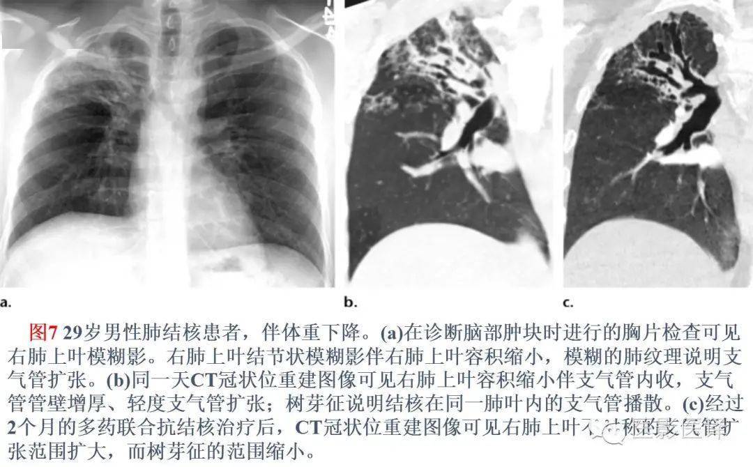 【图文详析】支气管扩张的机制,影像特征和病因