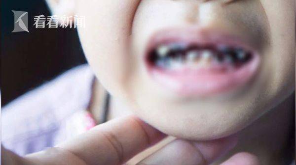 两岁孩子喜欢吃酸的 牙齿都腐蚀了怎么办