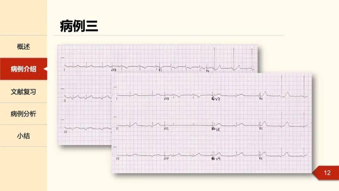 孔令秋教授:正后壁心肌梗死的定位困惑及心电图线索