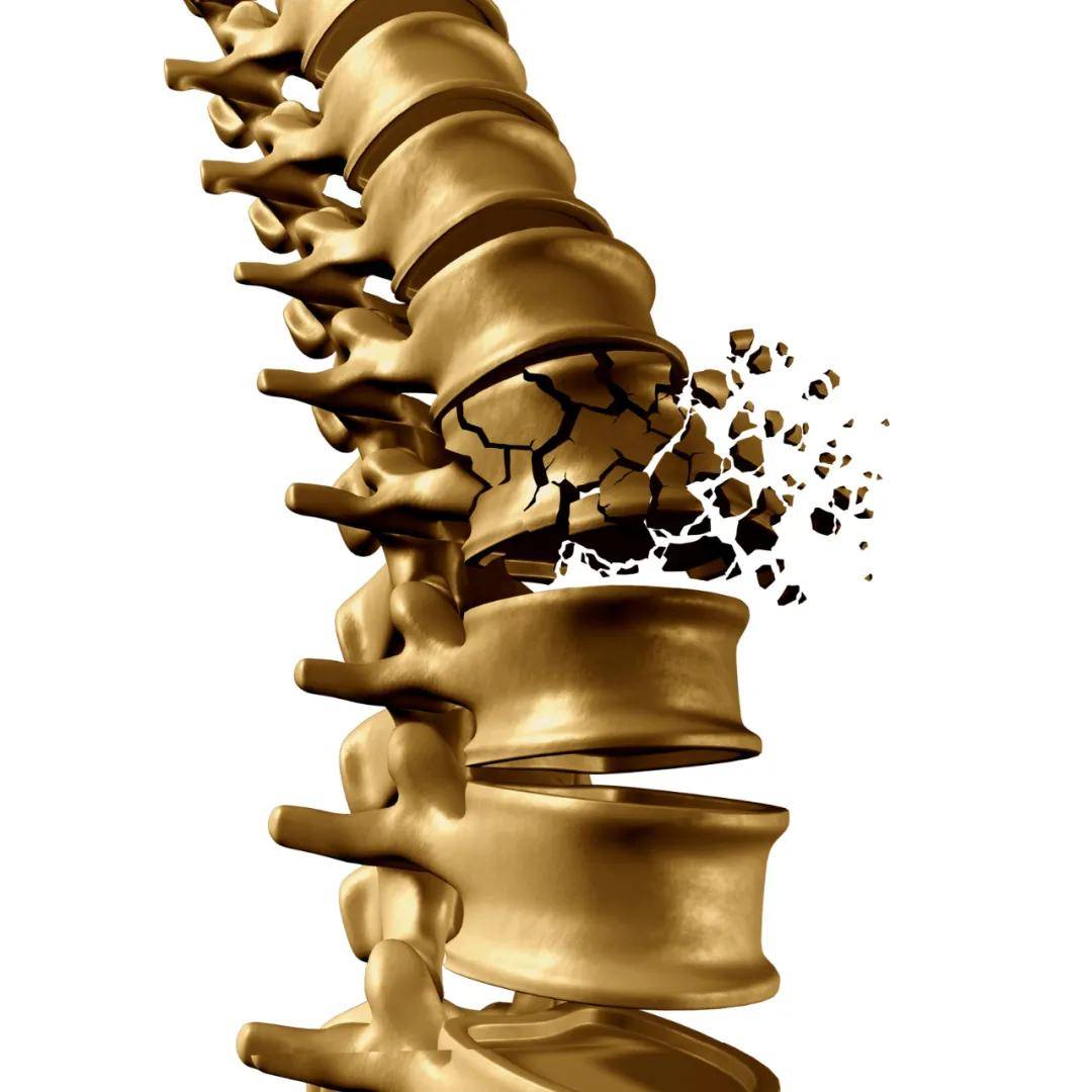 骨质疏松患者打个喷嚏就椎体压缩性骨折了?