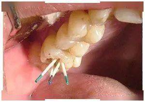治疗龋齿(俗称蛀牙),很多人都认为只要补上牙洞即可,所以不少患者