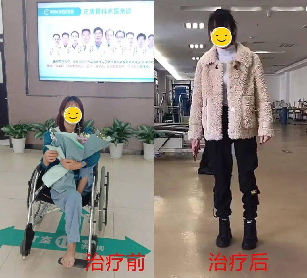 小儿麻痹症患者告别瘸拐在正康骨科医院正常行走