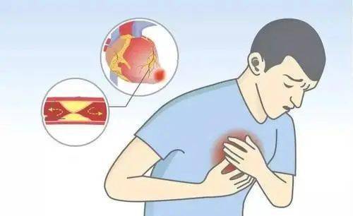 吃什么预防心梗脑梗最有效 9806489ca3f04d38930c68fb8830a2ec.jpeg