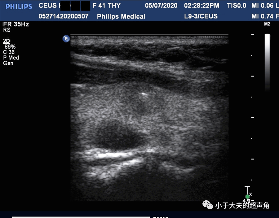 【超声随响】第45期 甲状腺乳头状癌 ptc