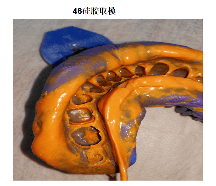 【病例】46重度弯曲根管治疗 纤维桩树脂核 全瓷冠修复
