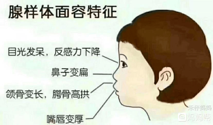 孩子变丑,不长个了!这个寒假,腺样体肥大的危害不容忽视!