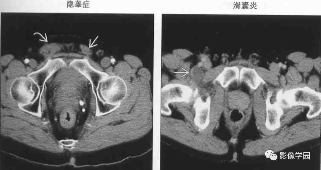 腹股沟区病变的影像鉴别诊断