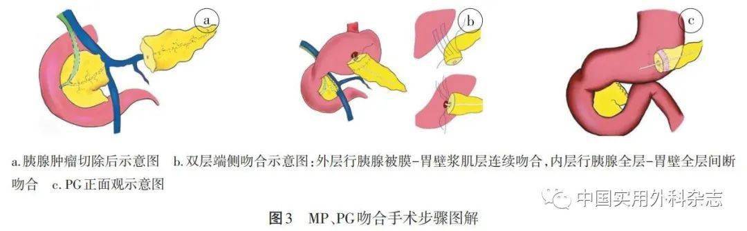 外圈行胰腺被膜-胃壁浆肌层连续吻合,并于wirsung管内放置胰管支架,可